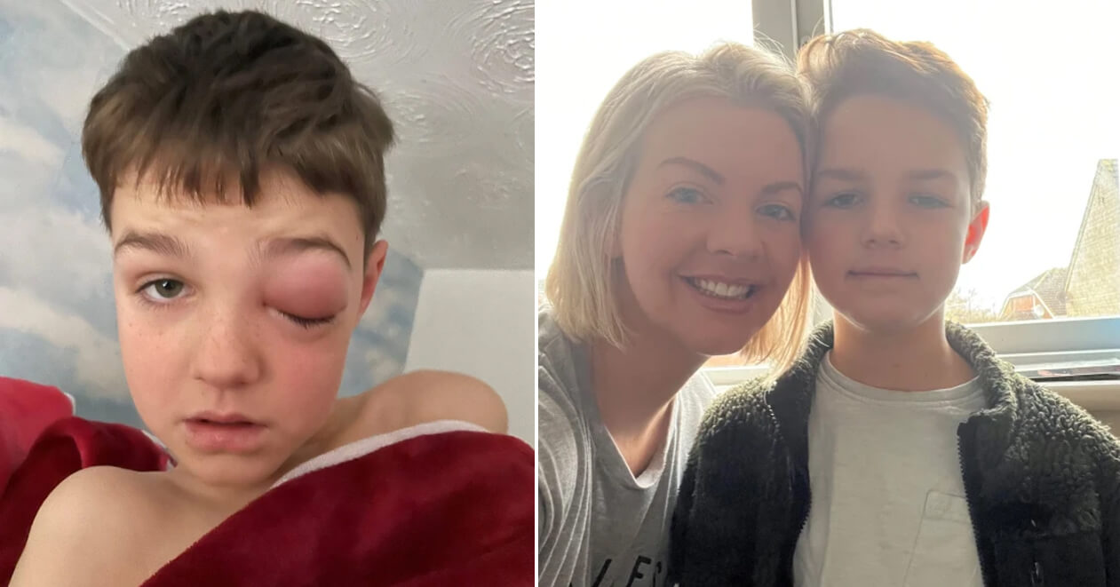 ઓમિક્રોને કરી દીધી આ 9 વર્ષના બાળકની ખરાબ હાલત, પોઝિટિવ હોયા બાદ 7 દિવસમાં ચાલી ગઇ આંખોની રોશની